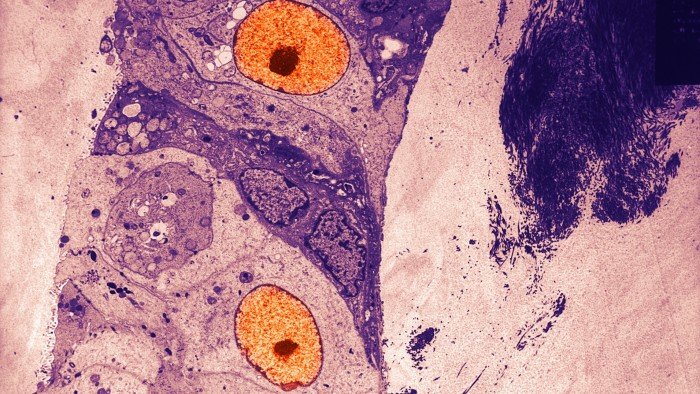 AstraZeneca unveils drug to treat mutating breast cancer before it starts to grow