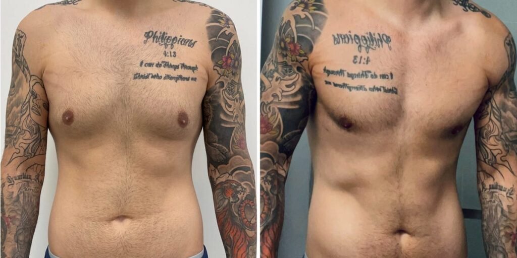 I Had Lipo on My Chest to Look More Masculine After Being Bullied