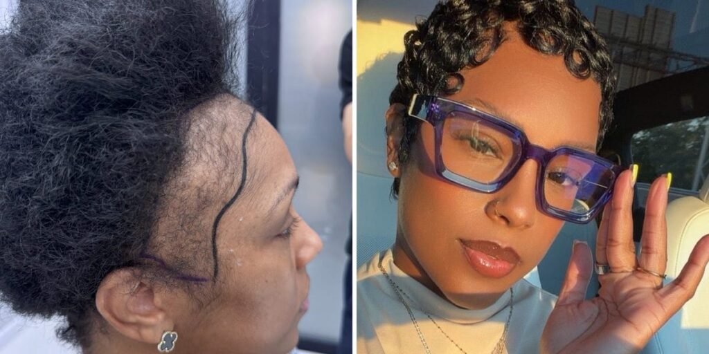 I Flew From the US to Turkey for a Hair Transplant Before My Wedding
