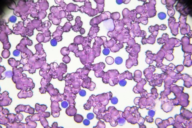 Eli Lilly’s Jaypirca gains additional indication for untreated leukemia, lymphoma